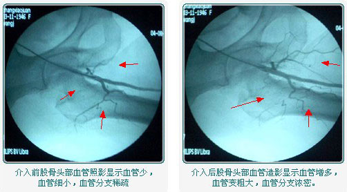 股骨头坏死如何治